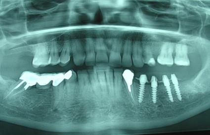 implants | Centre Dental Cise