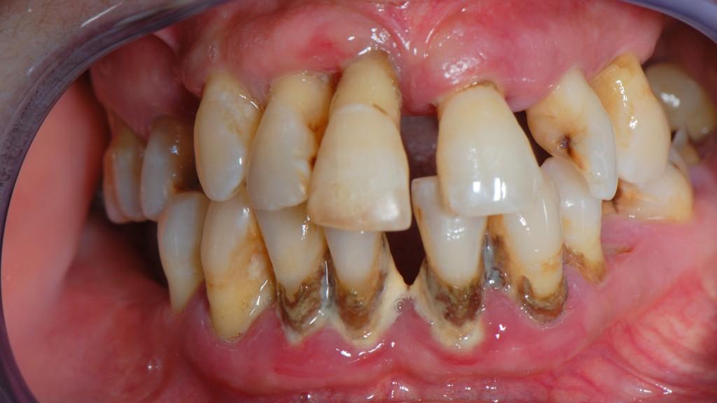 Malaltia Periodontal