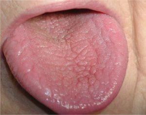 Relació entre diabetis i malalties orals | Centre Dental Cise