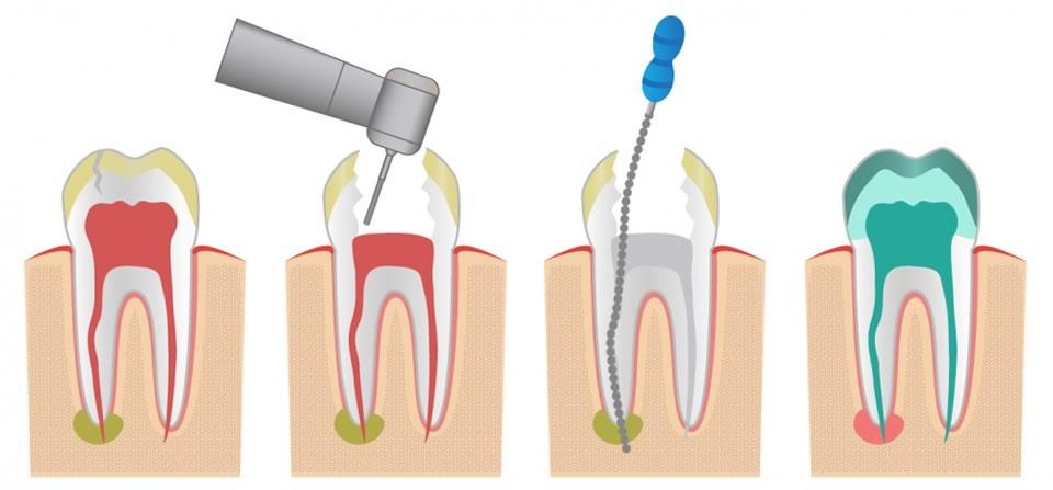 Endodòncia | Clínica Dental Cise | Figueres