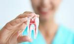 Què és una endodòncia | Clínica Dental Cise | Figueres