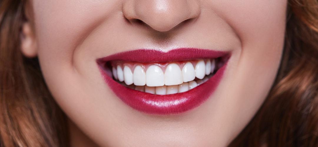 Carillas Dentales | Centre Dental Cise