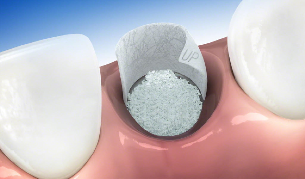 implantes dentales en Figueres