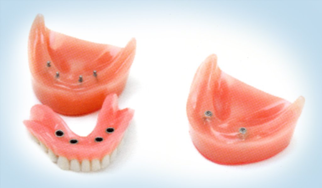 implantes dentales en Figueres