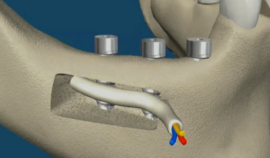 implantes dentales en Figueres