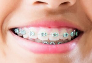 Ortodoncia en Figueres