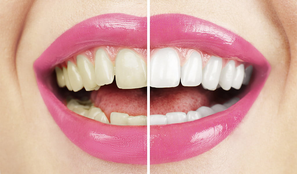 Estética dental a Figueres