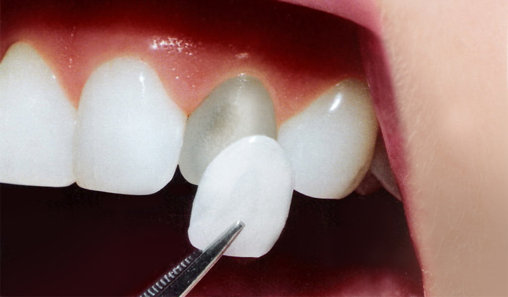 Estética dental a Figueres