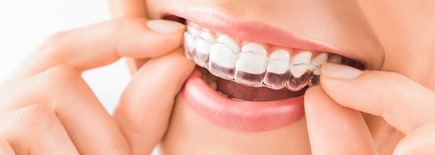 Centre Dental Cise - Figueres | Ortodoncia invisible